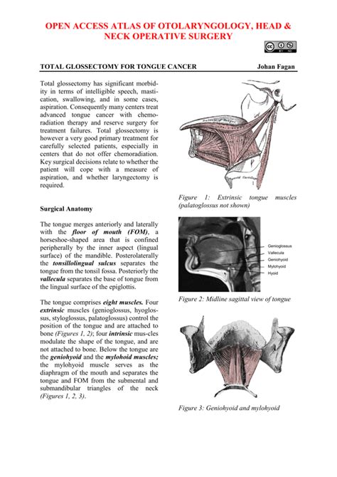 glossectomy vula